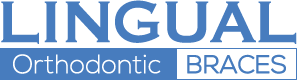 Lingual Orthodontic Braces Ireland